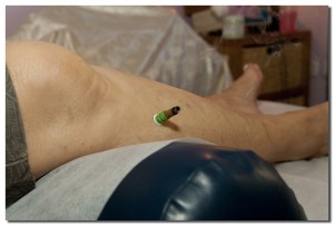 מיטל סומך, דיקור סיני, הוד השרון